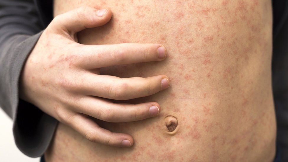 A photo showing the measles rash on a child