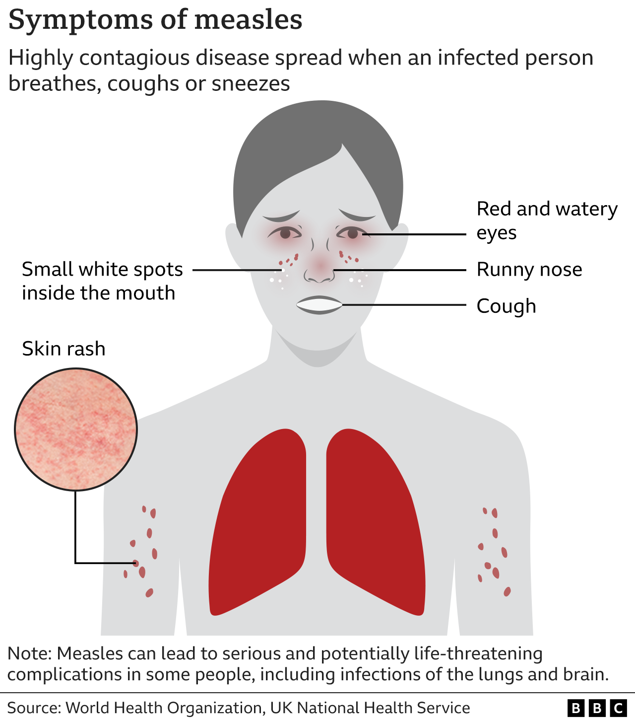Graphic showing main measles symptoms